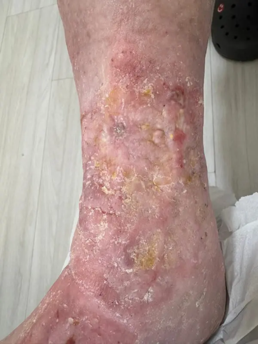 fuzari_goulart_campinas_pilates_fisioterapia_acupuntura_ozonioterapia_mesoterapia_estetica_antes_depois_v1_2